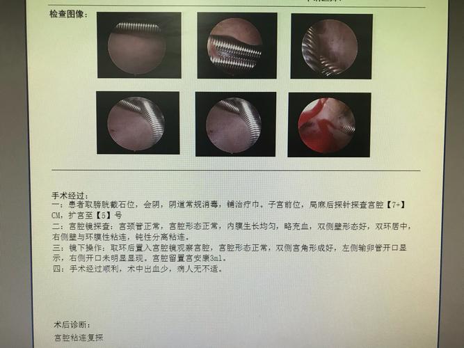 轻度宫腔粘连会自愈吗(跑步治好了宫腔粘连）