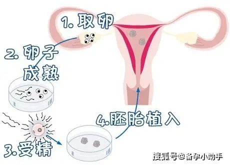 试管助孕男方取精困难怎么办(试管婴儿是怎么取精）