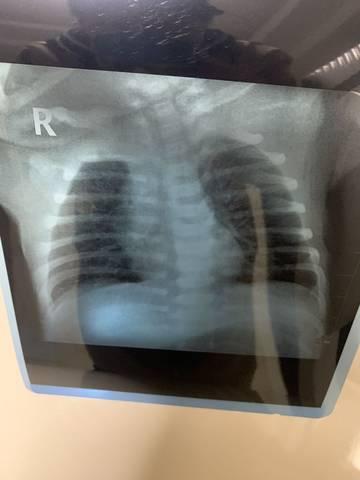 胸片做完多久可以怀孕(拍完胸片一个月后发现怀孕了）