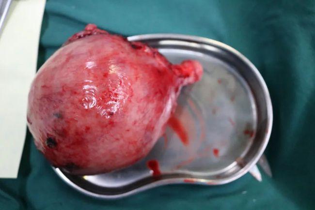 腺肌症早晚切除子宫吗(女人怎么会得腺肌症呢)