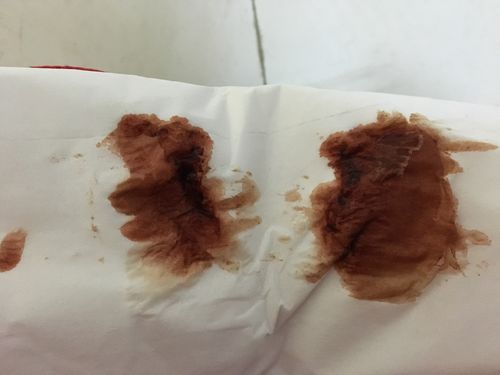 非经期少量出血褐色是怎么回事(没来月经但是有褐色血）