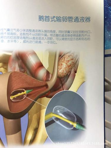 输卵管造影和输卵管通水有何区别？你知道吗？(输卵管怎么通开）