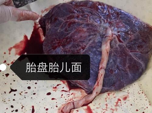 胎盘为什么会粘连(胎盘粘连常见吗）