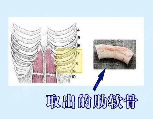 肋软骨缺一点会影响怀孕吗(肋软骨可以取几次）