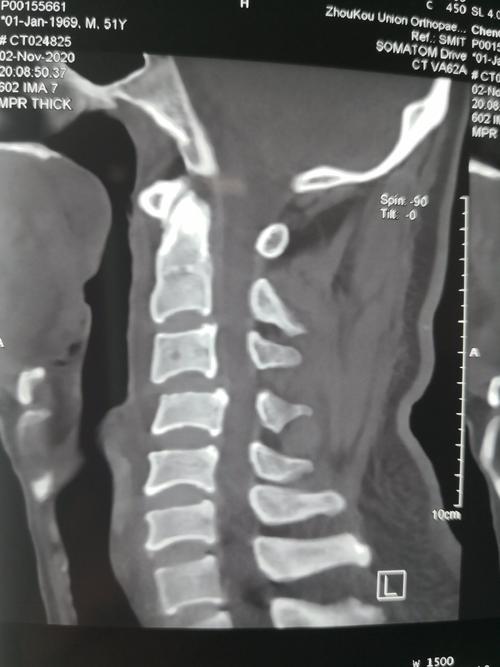 颈椎正侧位备孕可以拍片吗(做了颈椎ct后多久才能要孩子）