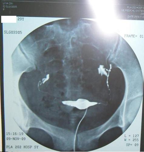 输卵管伞端粘连会怀孕吗(教你看输卵管造影片子）
