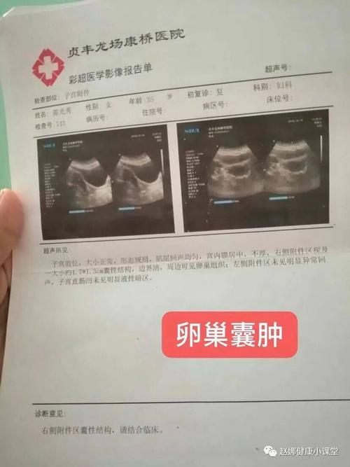 附件囊肿如何治疗(右侧卵巢囊肿怎么办）