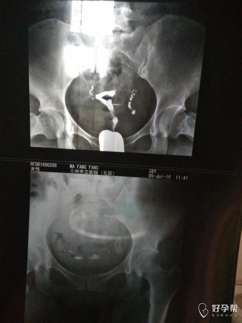 输卵管出现粘连是怎么回事？怎么才能怀孕呢？(输卵管粘连但是是通的）