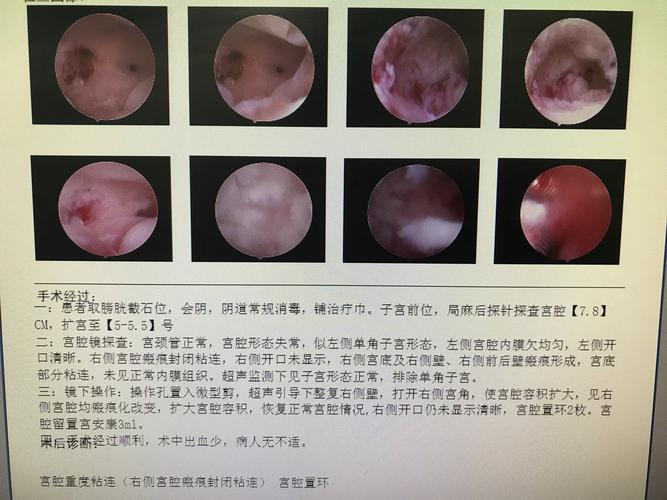 轻度宫腔粘连需要手术吗(子宫粘连一定要做手术吗)