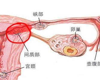 输卵管炎可以怀孕吗(输卵管炎症吃什么药好得快些）