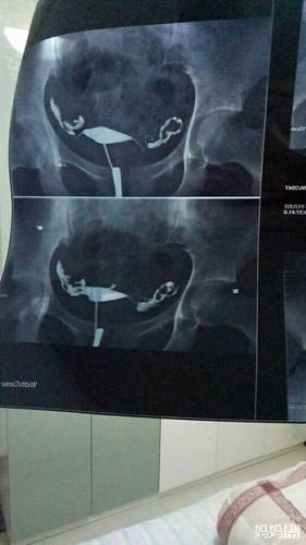 输卵管伞端粘连能自然受孕吗(输卵管伞端粘连是什么原因造成的）
