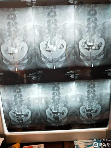 输卵管造影备孕的方法是怎样的(造影为什么有助于怀孕）