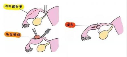 输卵管系膜囊肿是什么(输卵管系膜囊肿手术）