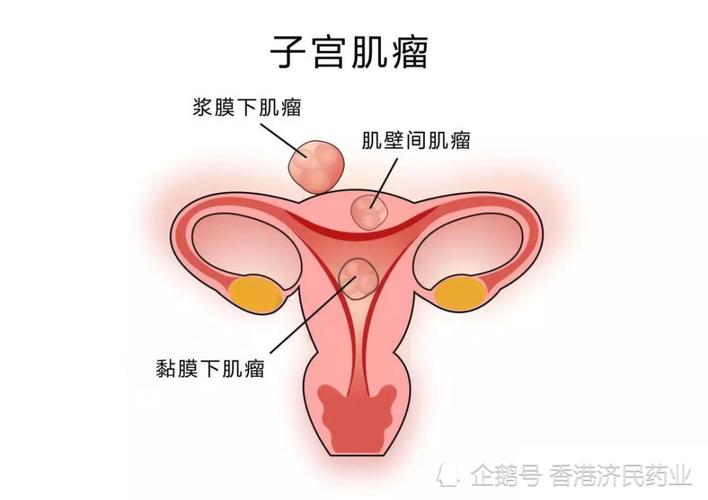 预防子宫肌瘤难不难？(多发子宫肌瘤）