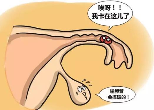 输卵管肿大的症状(输卵管图片高清真实图片）