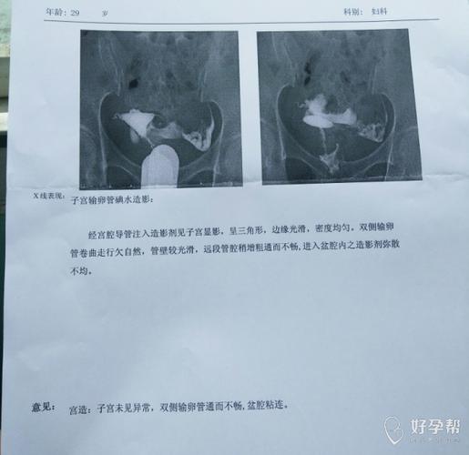 输卵管系膜囊肿需要手术吗(为什么医生不建议做输卵管造影）