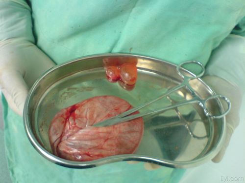 输卵管系膜囊肿严重吗(腹腔镜4个洞3个洞区别）