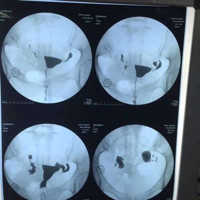 输卵管积水可以备孕吗(输卵管积水粘连还可以怀孕吗）