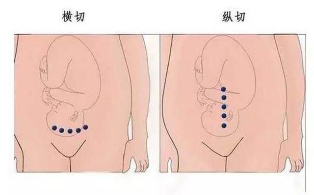 部腹产后怎么避孕最好(夫妻谁做结扎比较好）