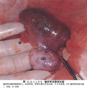 输卵管切除一边还可以怀孕吗(宫外孕说明男人的精子）