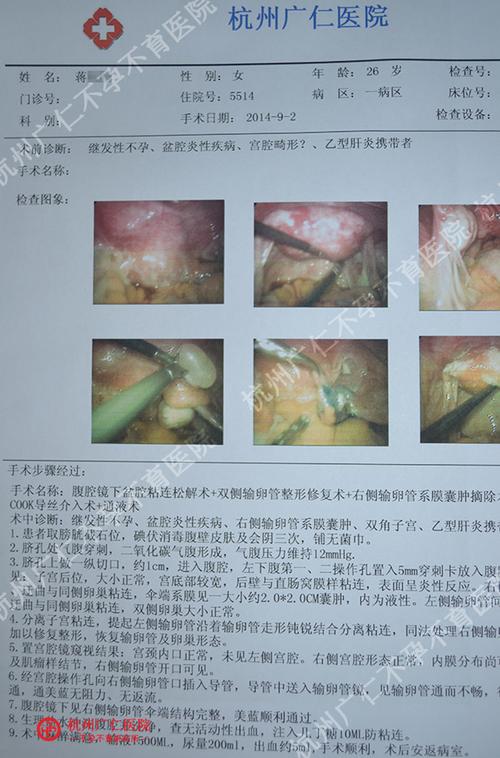 输卵管粘连手术费用(宫颈粘连可以自愈吗）