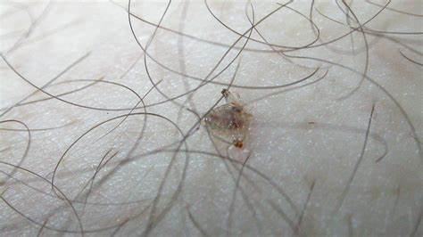 阴虱会乱爬吗阴虱真的会爬遍全身吗?(阴虱会爬到孩子身上吗)