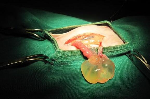 输卵管系膜囊肿怎么引起的(输卵管系膜囊肿怎么治疗）