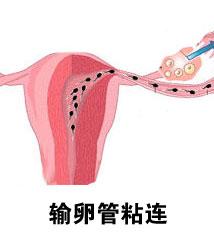 输卵管肿大怎么治疗最好(输卵管水肿严重必须要切除吗）