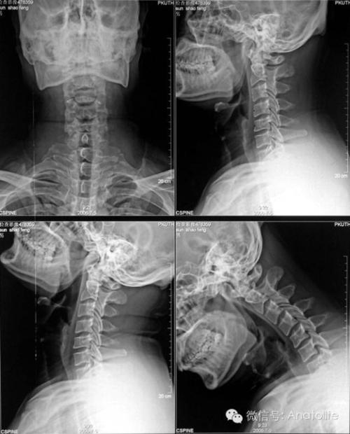 颈椎正侧位如何备孕(备孕期能吃八正颗粒吗）