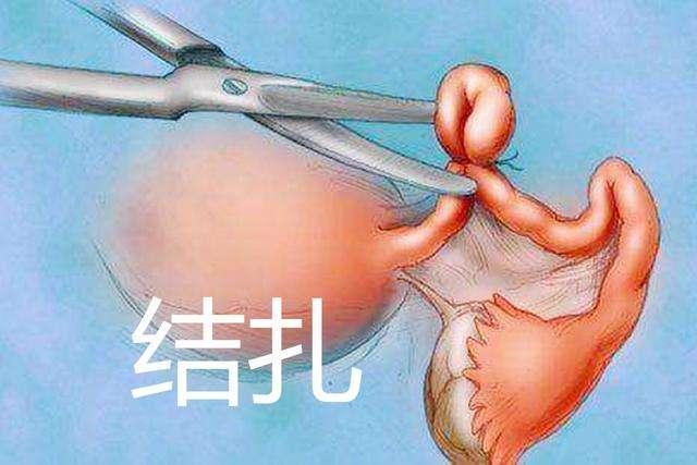 部腹产后怎么避孕最好(夫妻谁做结扎比较好）