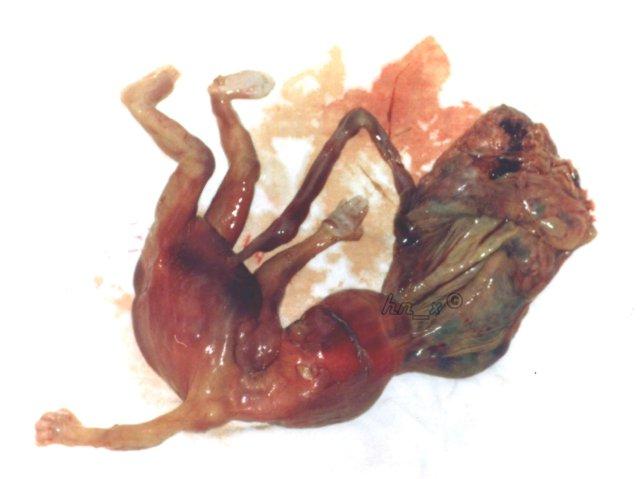 胎儿无脑畸形再备孕可以吗(有一胎畸形下胎还会吗）