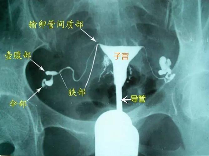 输卵管炎可以同房吗(输卵管造影全过程图解）