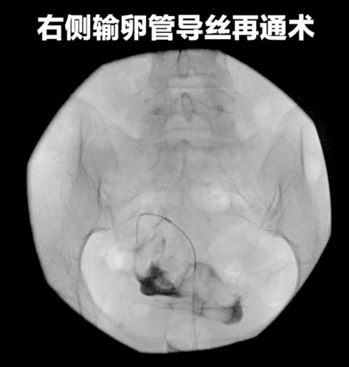 输卵管不通介入治疗能顺利怀孕吗(输卵管介入后多久会堵)