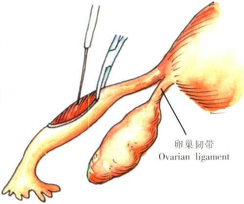 输卵管堵塞想要娃，选试管婴儿还是腹腔镜？(输卵管堵塞手术怎么做）