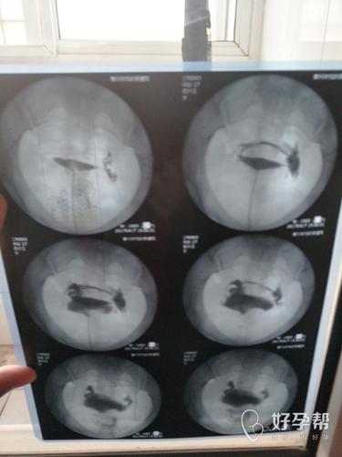 输卵管炎可以吃辣椒吗(输卵管造影后多久不能吃辣椒）