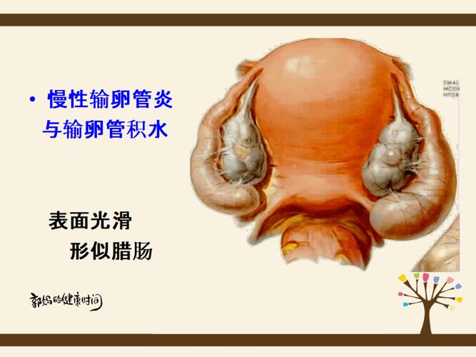 输卵管炎是盆腔炎吗(慢性输卵管炎什么症状）