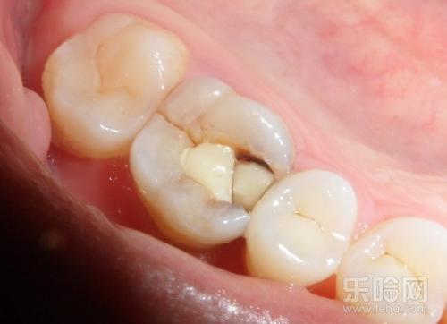 蛀牙怀孕前一定要拔吗(龋齿不拔对怀孕的影响）