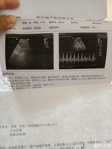 胎心率是怎么看男女的胎心率和宝宝性别有关吗(胎心率150是男孩还是女孩)