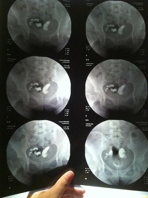 输卵管堵塞有征兆吗这五种情况警示输卵管出了问题(输卵管闭塞）