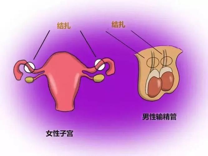 输卵管结扎对女性危害大，你还敢如此避孕吗？(女性结扎的危害有哪些）