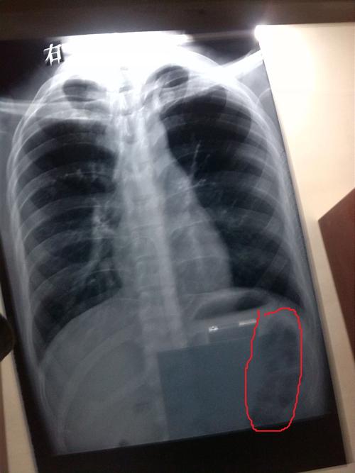 胸片后多久可以怀孕(拍完胸片一周后怀孕了）