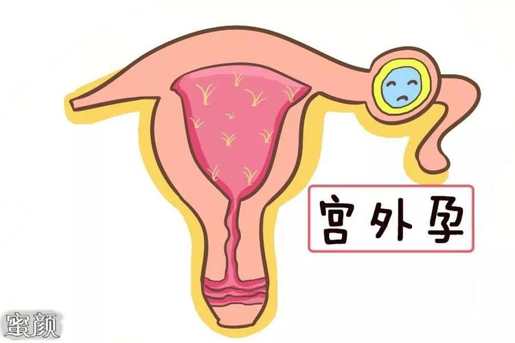 试管婴儿能避免宫外孕吗试管婴儿可能出现宫外孕的几种情况(试管婴儿宫外孕的原因）