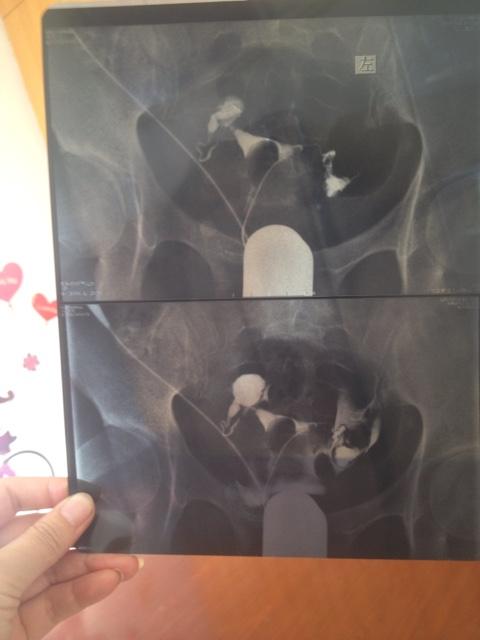 输卵管通为什么没怀孕(通而不畅造影后易孕）