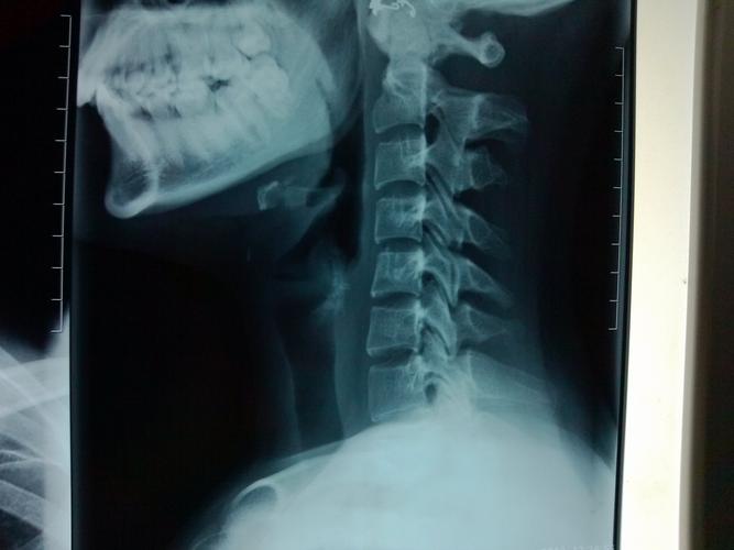 颈椎X光后多久可以怀孕(颈椎DR多久后可以备孕）