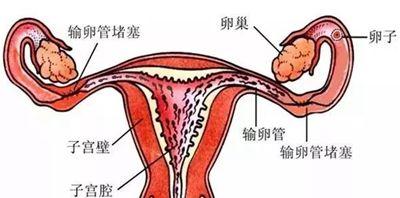 输卵管堵塞的症状(女人怎么会输卵管堵塞）