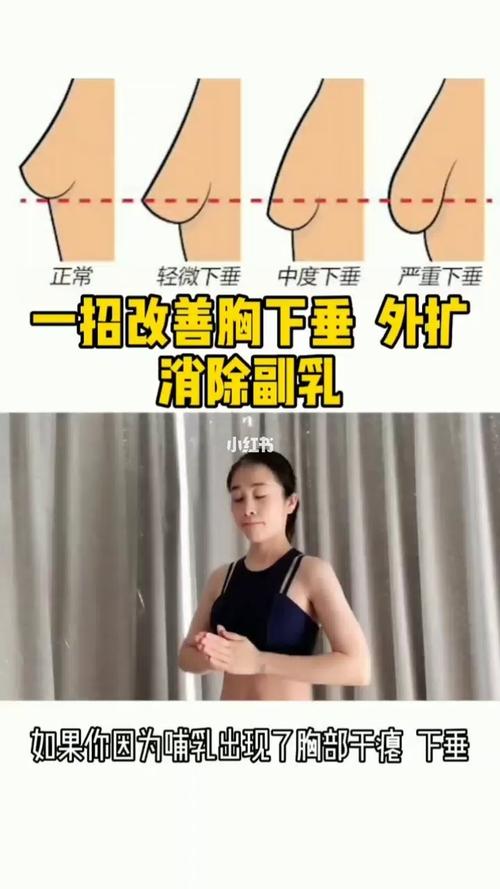 胸外扩下垂怎么改善(如何判断胸下垂和外扩）