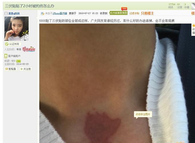 贴三伏贴后起水泡正常吗(贴了三伏贴皮肤红肿起水泡怎么办）