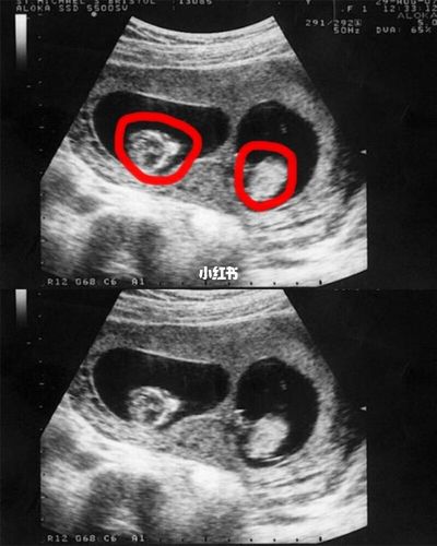 试管怀双胞胎需要什么条件(怀双胞胎第一个月症状)