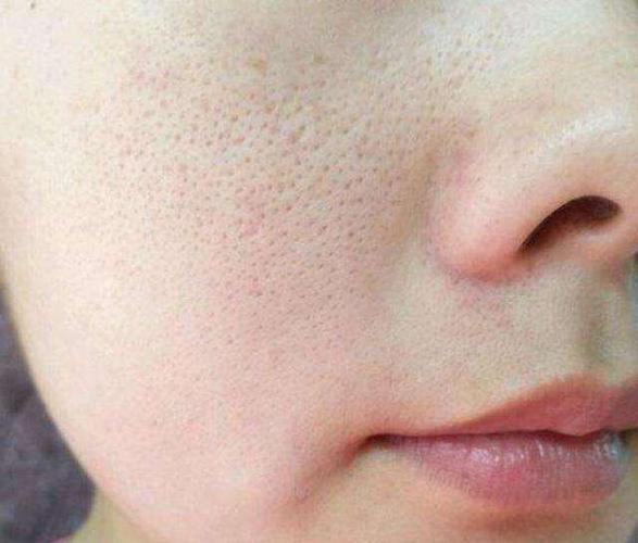 裸睡会吸引螨虫吗怎样才能去除螨虫呢？(去除脸上螨虫的小妙招）