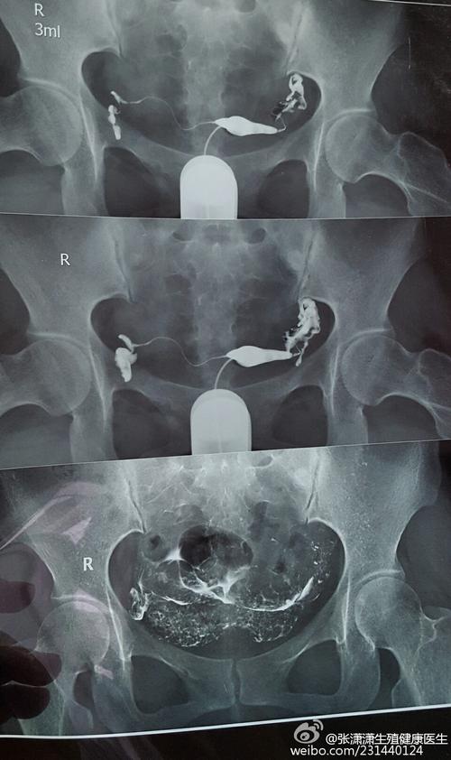 输卵管造影疼吗(输卵管切除了还可以修复吗）